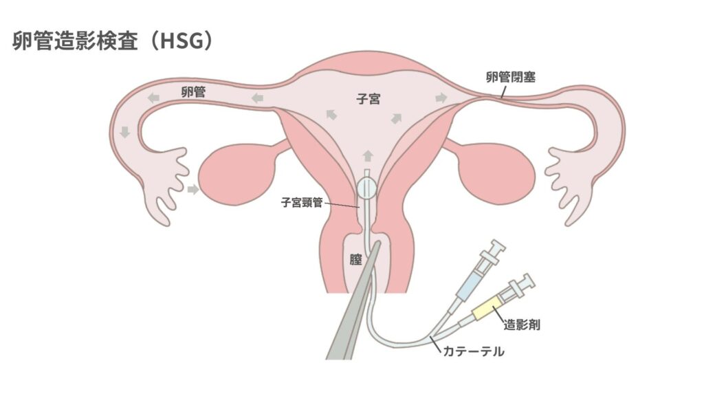 卵管造影検査(HSG)のしくみ。子宮の入口からカテーテルで造影剤を入れ、卵管の中を流れる様子を見る