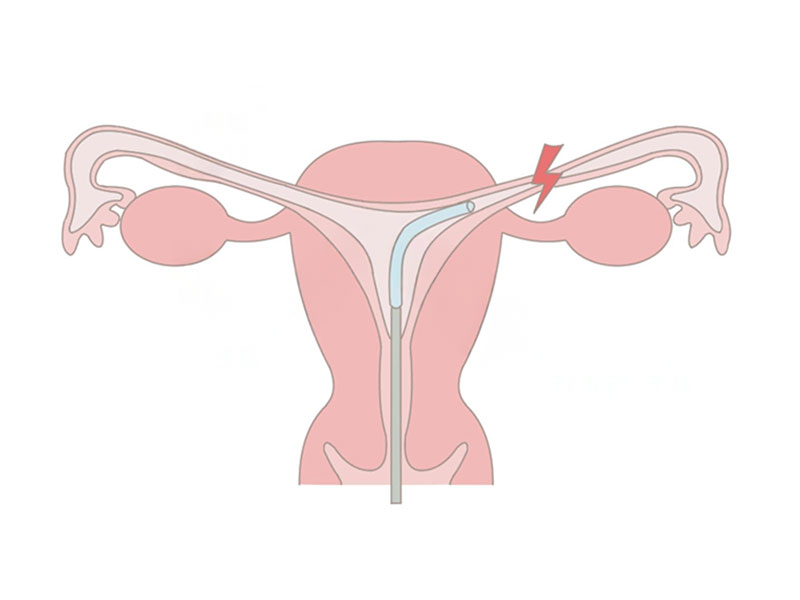 卵管鏡下卵管形成術（FT）