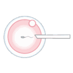 受精（媒精）- 顕微授精（ICSI）